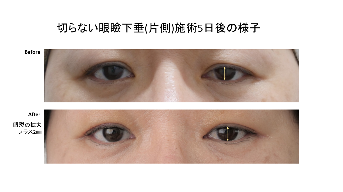 切らない眼瞼下垂のご紹介です！