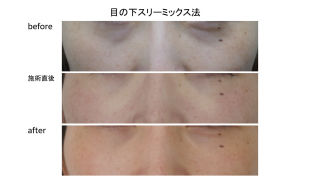 目の下スリーミックス法を施術された方の症例のご紹介です！