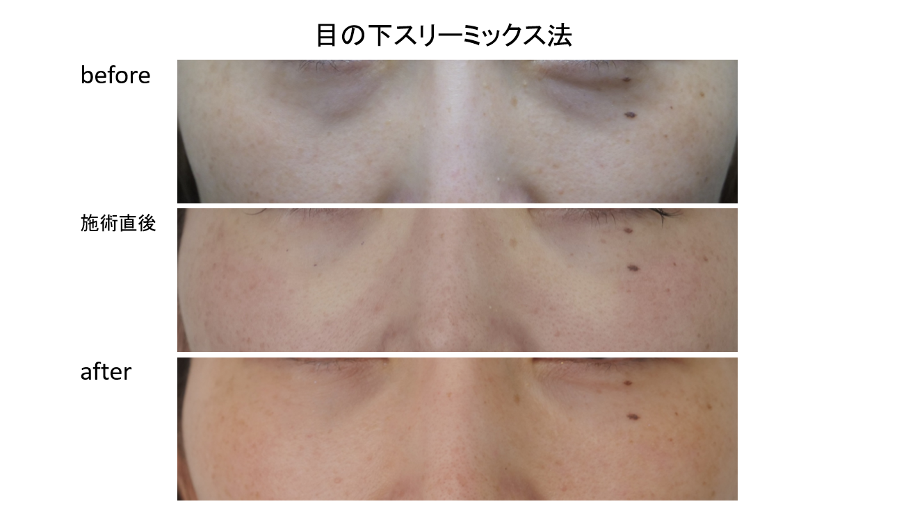 目の下スリーミックス法を施術された方の症例のご紹介です！