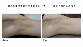 脇の色素沈着諦めていませんか？静岡美容外科橋本クリニックなら治療出来ます!