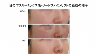 切らない目の下たるみ取り(スリーミックス法)で若返り！症例のご紹介です。