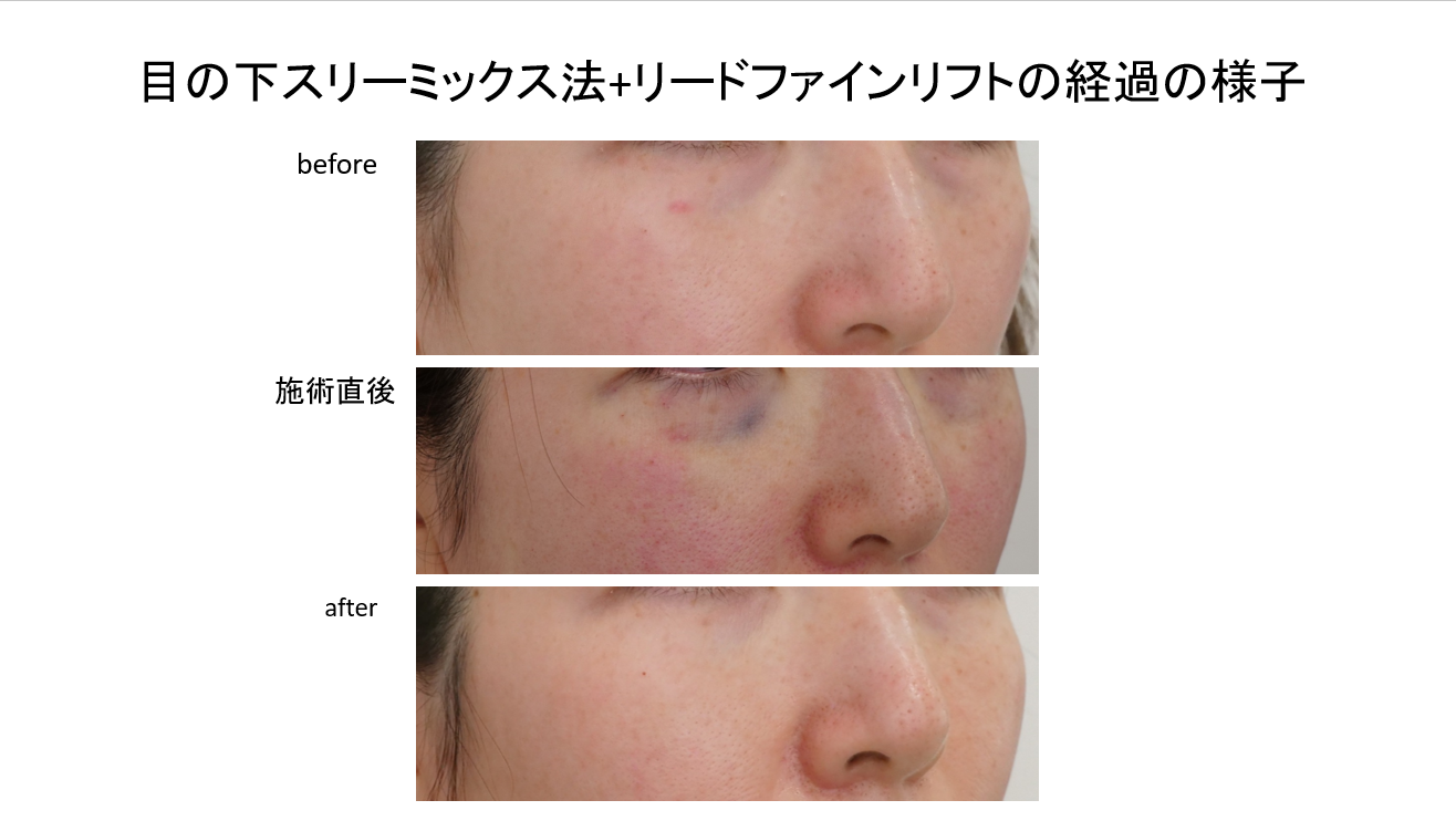 切らない目の下たるみ取り(スリーミックス法)で若返り！症例のご紹介です。