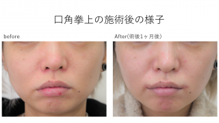 口角挙上リフト術後1ヶ月の様子の紹介です。