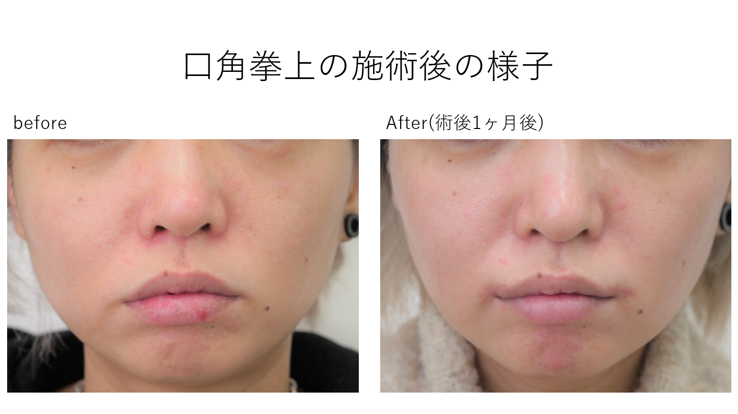 口角挙上リフト術後1ヶ月の様子の紹介です。