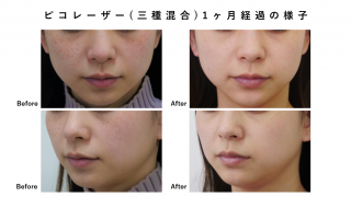 シミ取り治療(三種混合)の症例紹介です！