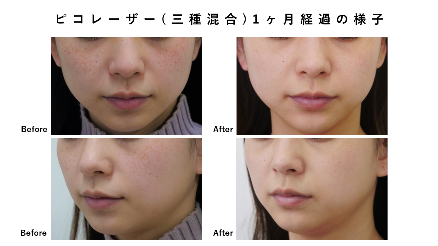 シミ取り治療(三種混合)の症例紹介です！