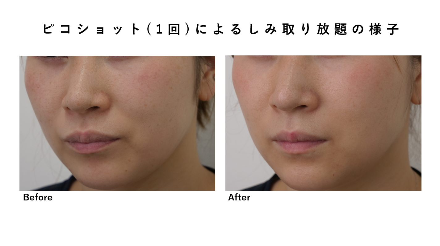 産後に濃くなったシミにもピコショットは有効です！症例紹介も含めて！
