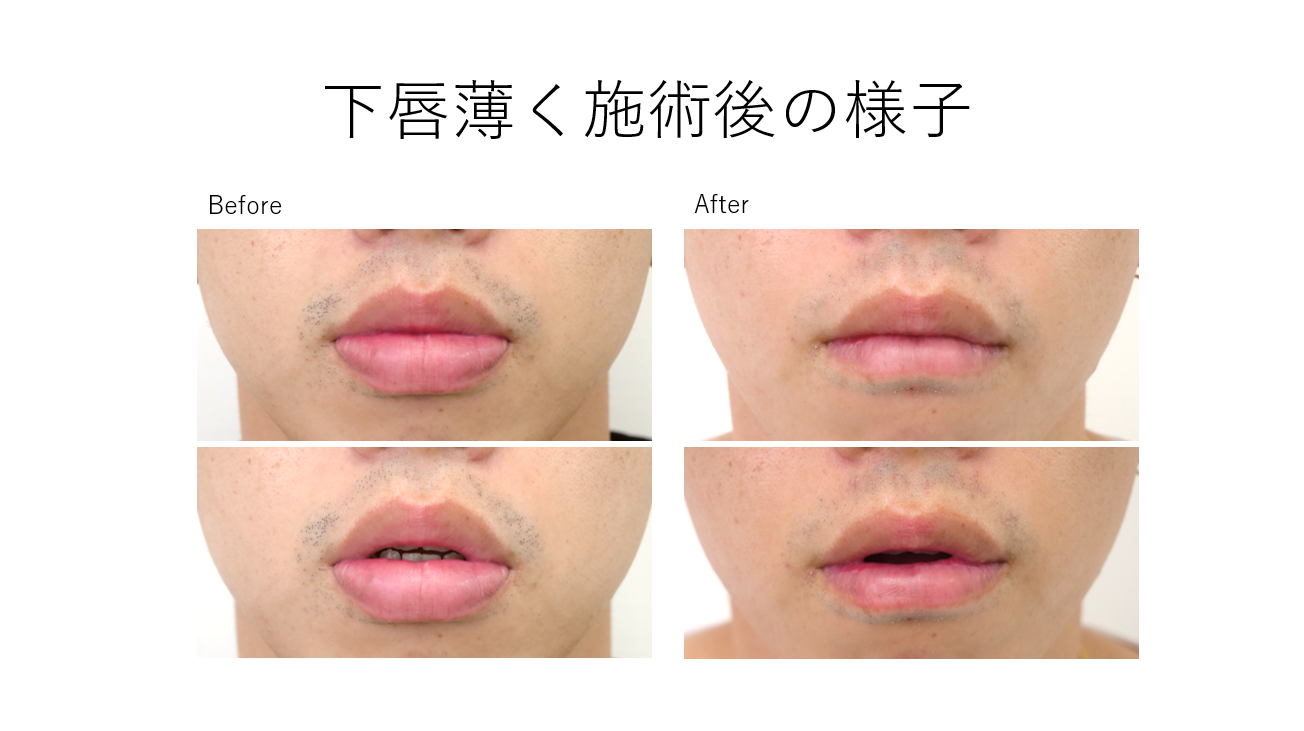 下唇薄く！症例紹介です！