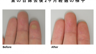 当院の魚の目治療の紹介です！