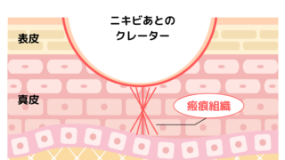 静岡美容外科橋本クリニックのニキビ跡治療のサブシジョンが他と違う3つの理由！