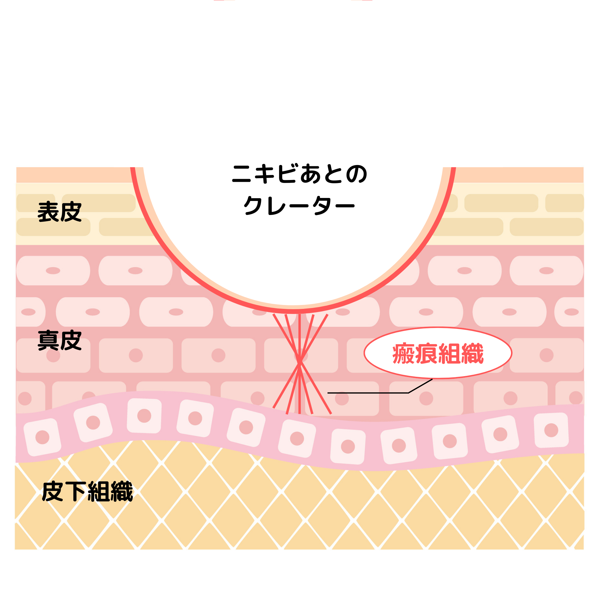 静岡美容外科橋本クリニックのニキビ跡治療のサブシジョンが他と違う3つの理由！