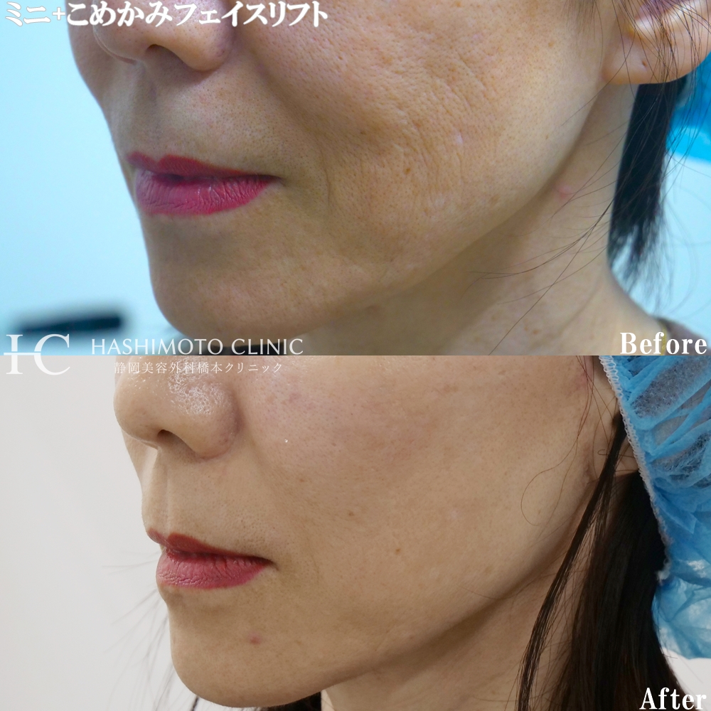 フェイスリフトのモニター様の紹介です！