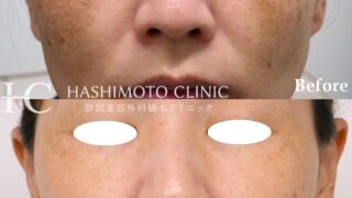ピコレーザーが著効した肝斑症例の紹介です！