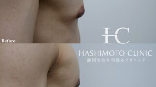 男性型乳腺症（女性化乳房）に対しての乳輪下切開アプローチ乳腺切除を行った1例