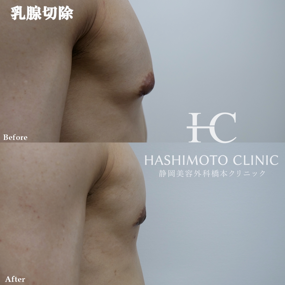 男性型乳腺症（女性化乳房）に対しての乳輪下切開アプローチ乳腺切除を行った1例