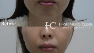 静岡美容外科橋本クリニックで行った脂肪溶解注射で小顔施術モニター様の紹介です！
