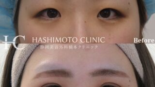 二重埋没法＋瞼の脂肪取り＋目頭切開（Z法）のモニター様のご紹介です！