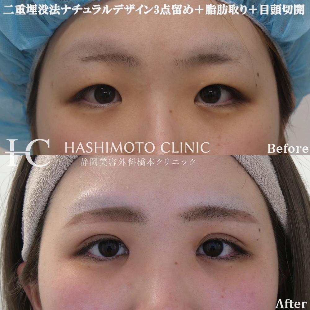 二重埋没法＋瞼の脂肪取り＋目頭切開（Z法）のモニター様のご紹介です！