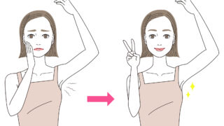 【症例紹介】他院で2回失敗したワキガ手術！しつこい汗腺を完全撃破の巻き！