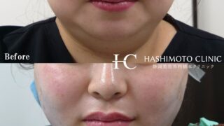 顔の脂肪吸引＋糸リフトがお得になりました！モニター様のご紹介も