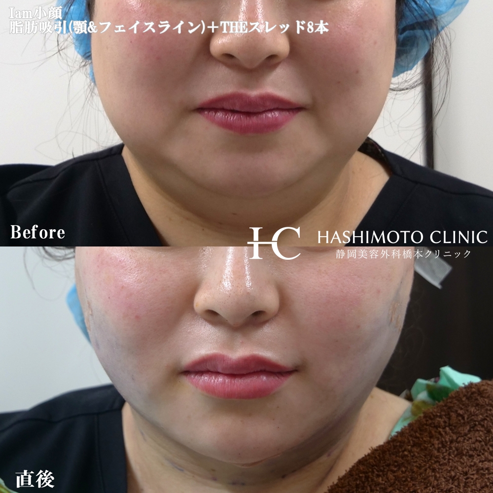 顔の脂肪吸引＋糸リフトがお得になりました！モニター様のご紹介も