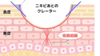 静岡美容外科橋本クリニックのオリジナル スリーミックスサブシジョンが 高い効果を出せる理由