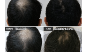 当院のAGA治療薬と副作用の頭髪の以外の多毛化に対する医療脱毛照射について