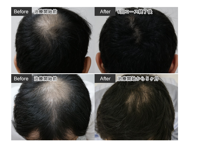 当院のAGA治療薬と副作用の頭髪の以外の多毛化に対する医療脱毛照射について