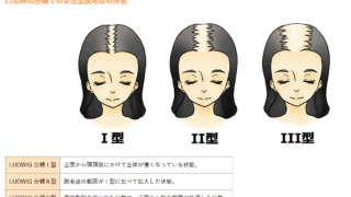 静岡美容外科橋本クリニックの女性の薄毛（FAGA）の特徴