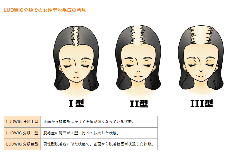 静岡美容外科橋本クリニックの女性の薄毛（FAGA）の特徴