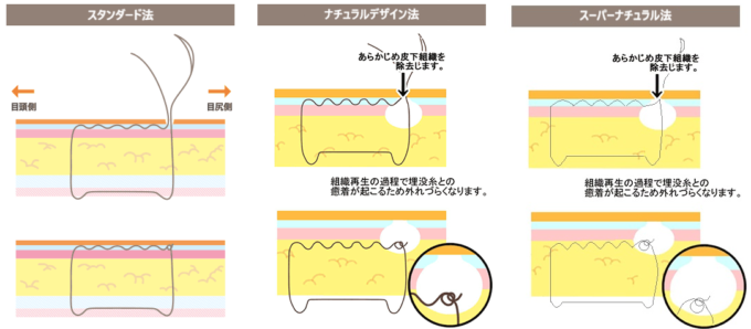 二重埋没法の術式