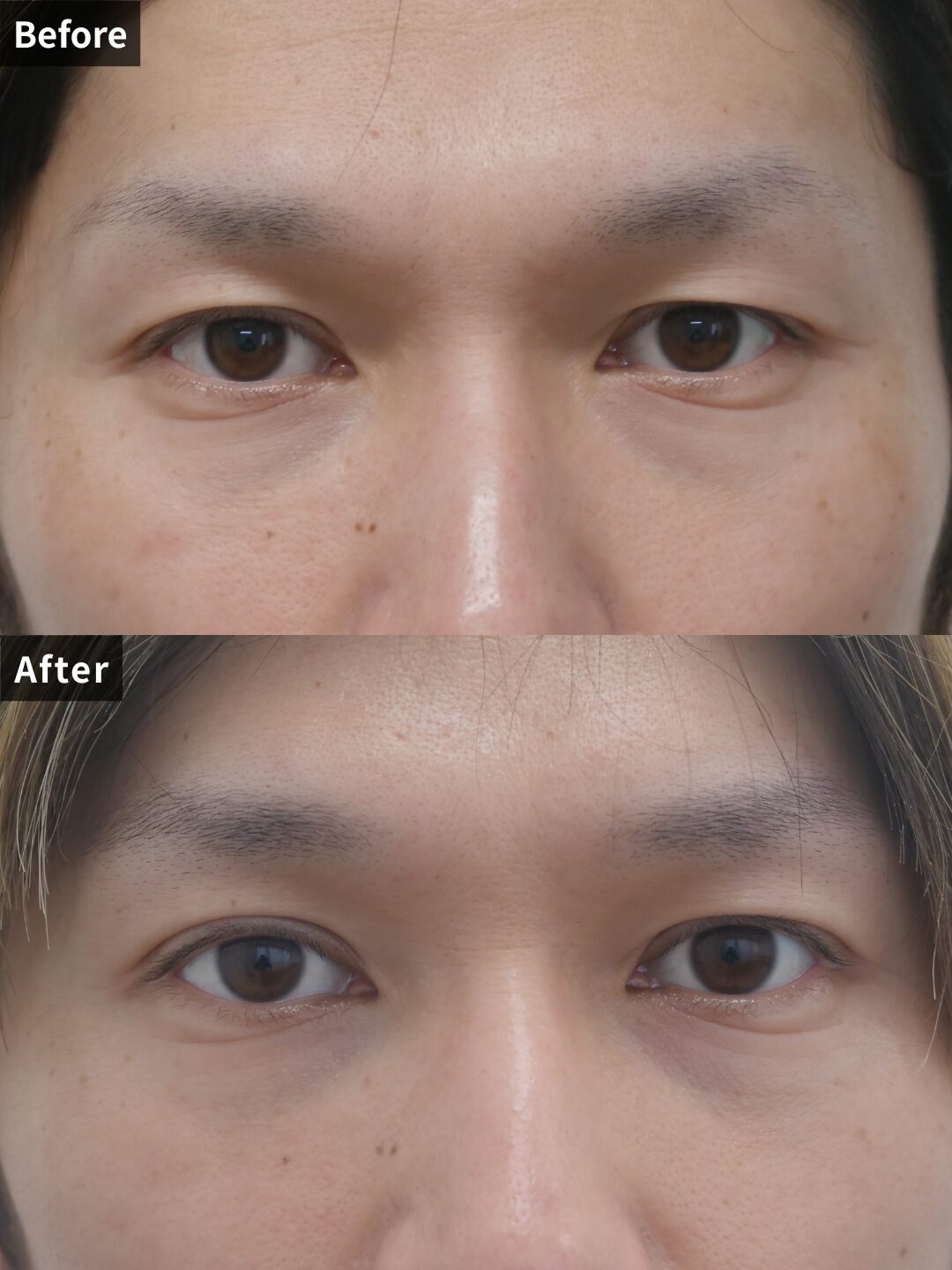 ＃103（30代 男性）二重埋没法ナチュラルデザイン2点留め