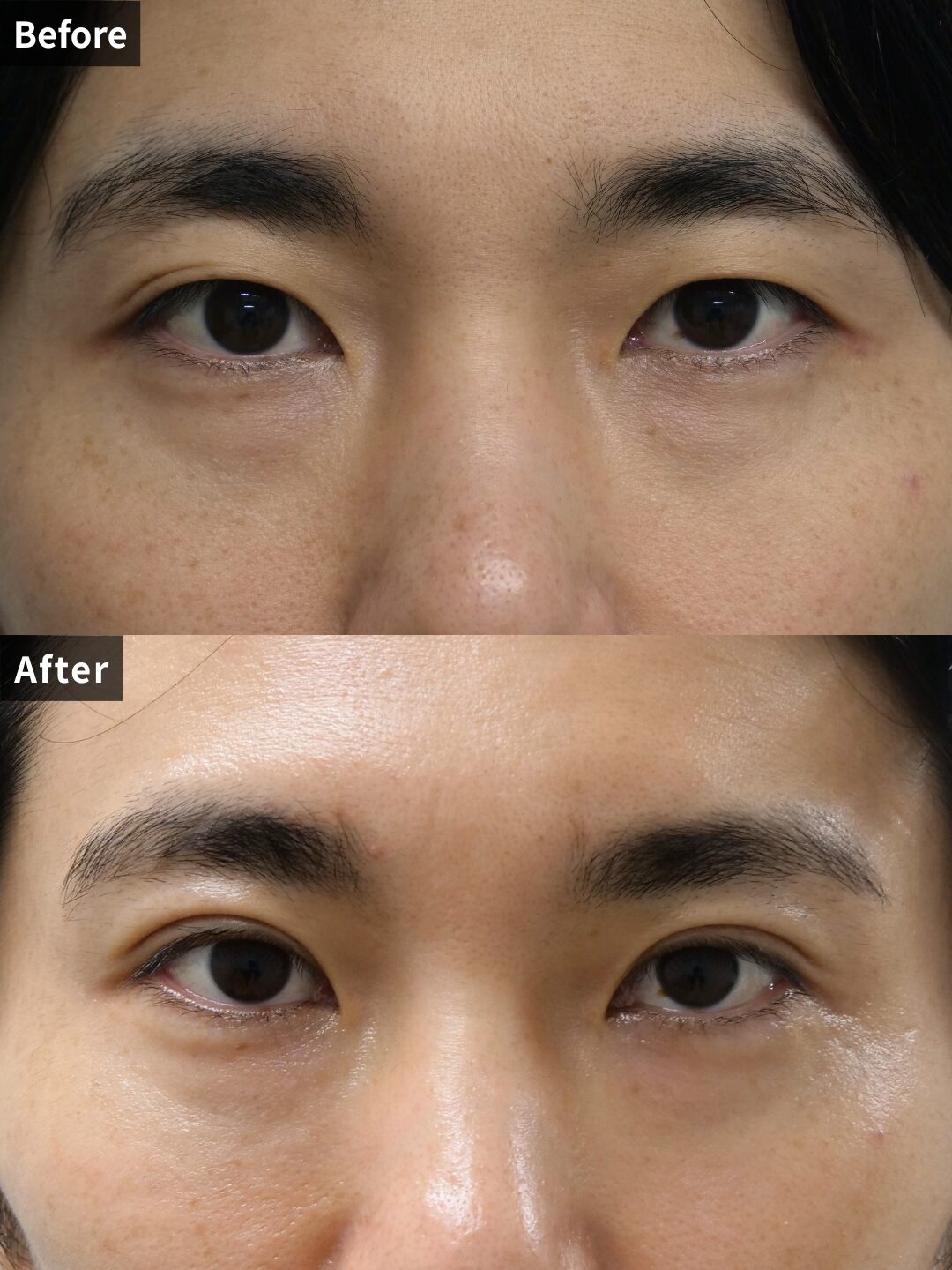 ＃104（30代 男性）二重埋没法スーパーナチュラル3点留め　