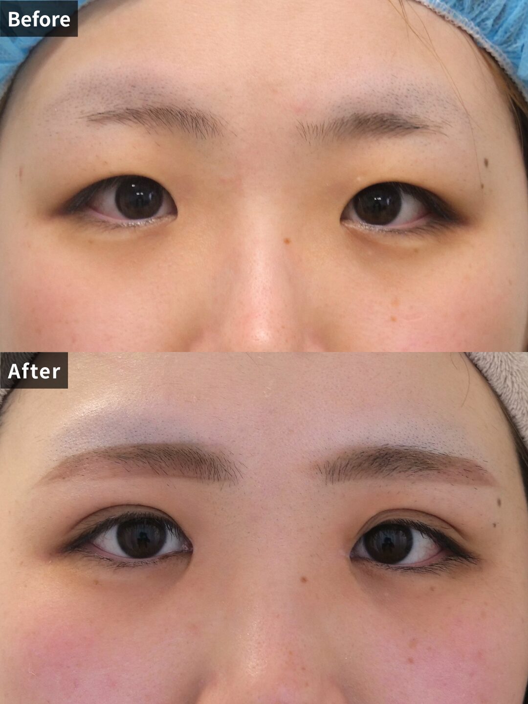 ＃112（20代 女性）二重埋没法ナチュラルデザイン3点留め／上まぶた切らない脂肪取り／目頭切開