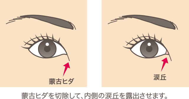 目頭切開法の詳細