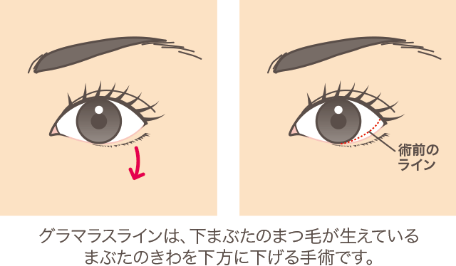 グラマラスライン（たれ目形成）の説明