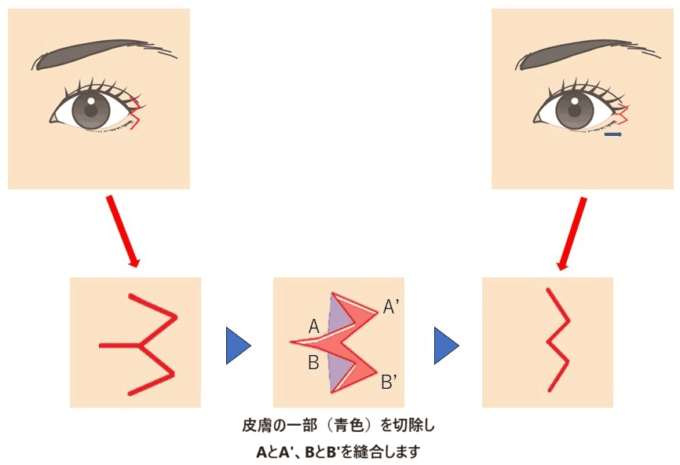 たれ目尻切開の説明