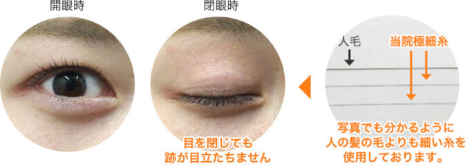 埋没法で使用する糸