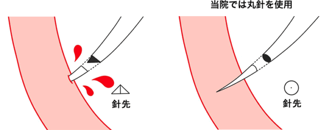 二重埋没法で使用する丸針