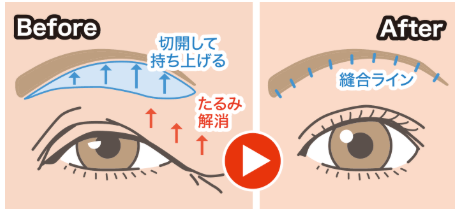 眉毛下切開法の説明