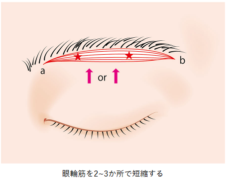 眼輪筋短縮(眉毛下切開オプション)の説明