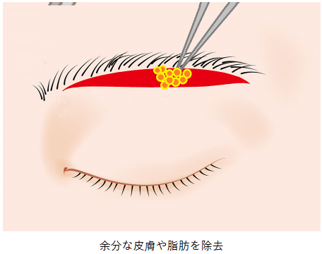 ROOF切除法（眉毛下切開オプション）の説明