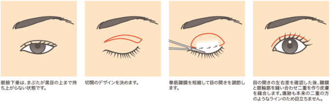 目の上たるみ取り(切る眼瞼下垂)の施術方法
