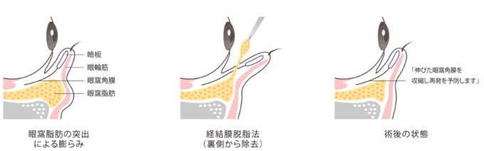 目の下たるみ取りの施術方法