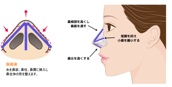 糸による切らない隆鼻術の説明