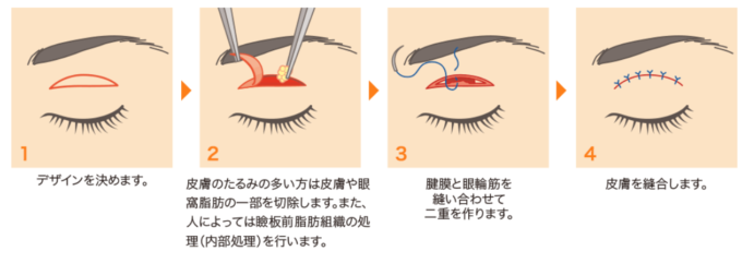 二重全切開法の説明