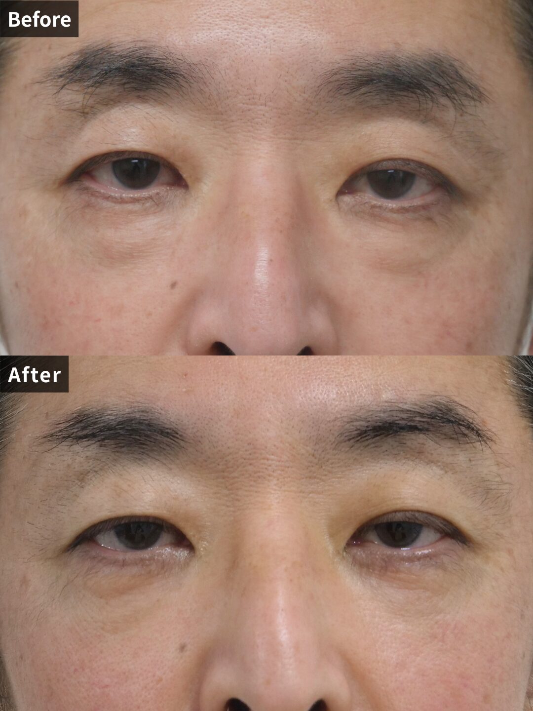 ＃116（50代 男性）目の下スリーミックス法