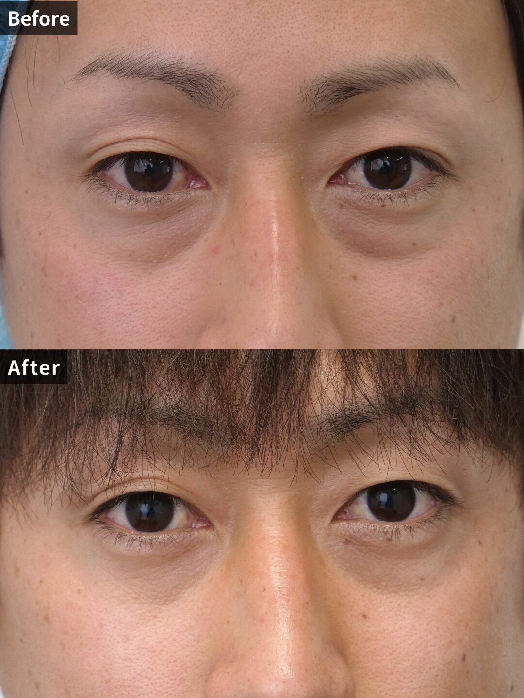＃120（30代 男性）目の下スリーミックス法