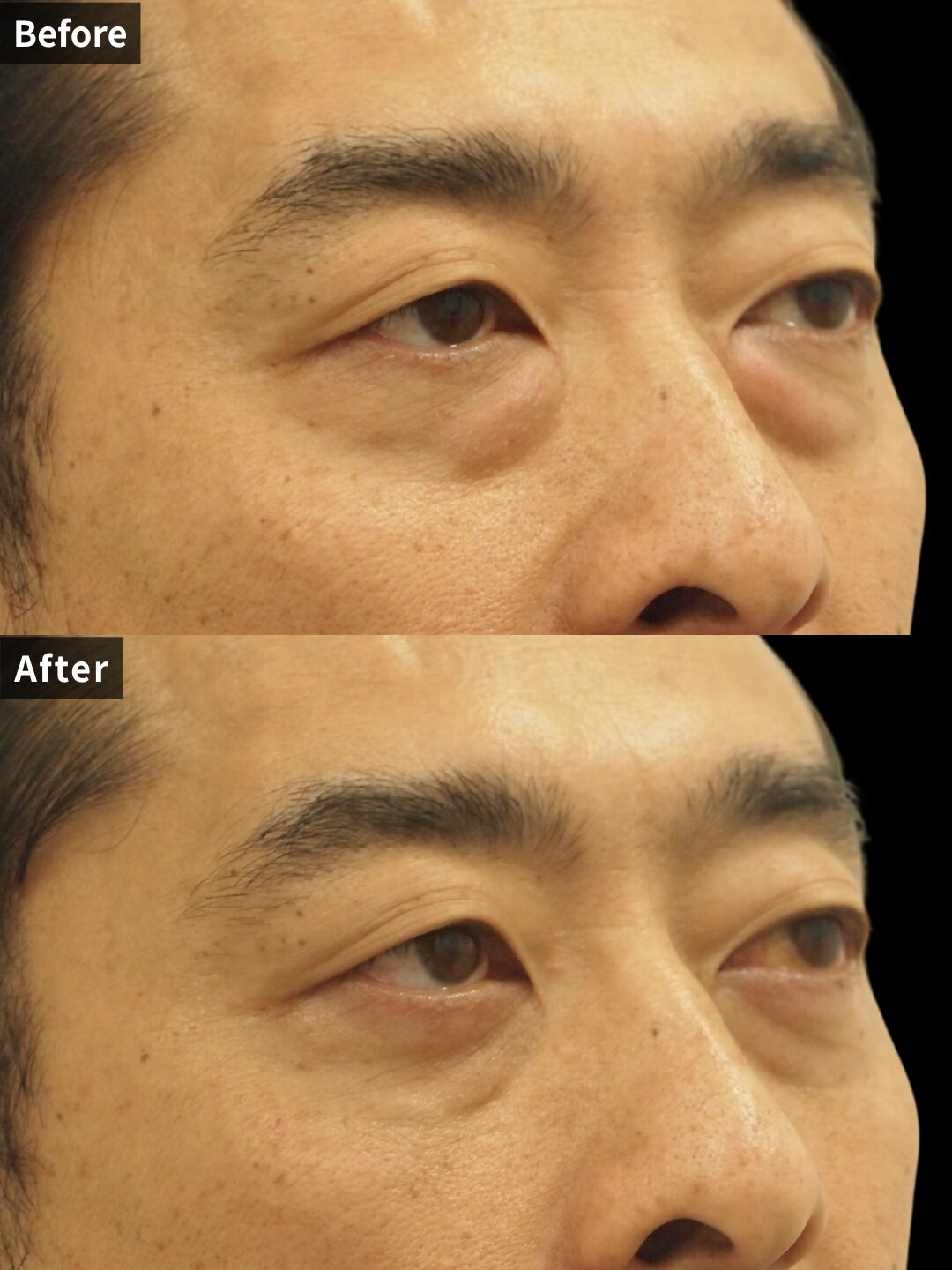 ＃124（40代 男性）目の下スリーミックス法の症例 2