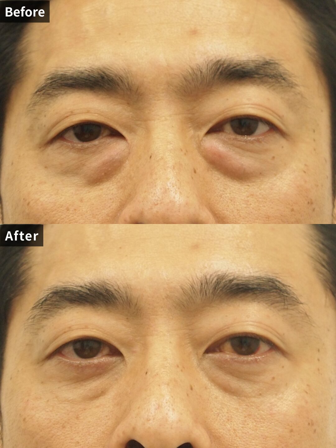 ＃124（40代 男性）目の下スリーミックス法